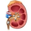 Kidney Stones Symptoms in Men – Causes and Remedies
