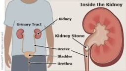 Causes of Kidney Stones in Women