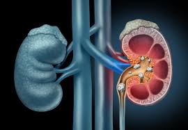 Kidney Stones Symptoms in Men – Causes and Remedies