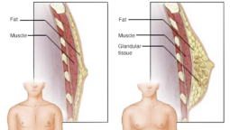 Gynaecomastia