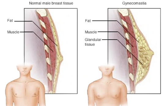 Gynaecomastia