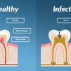 Symptoms of Tooth Infection Spreading to Body