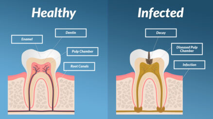 Symptoms of Tooth Infection Spreading to Body