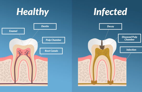 Symptoms of Tooth Infection Spreading to Body