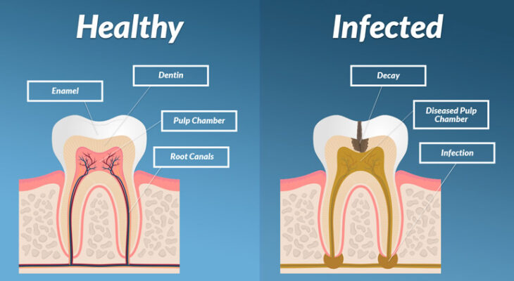 Symptoms Of Tooth Infection Spreading To Body