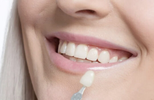 Why Veneers Are Cheap In Turkey