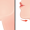 Double Chin Reduction for a Newly Confident Profile