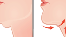 Double Chin Reduction for a Newly Confident Profile