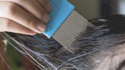 Types, Causes, Diagnosis and Treatment of Head Lice