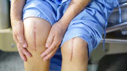 Why Should You Consider Knee Replacement Surgery?