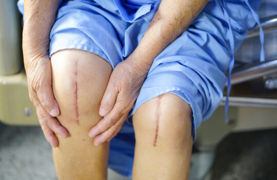 Why Should You Consider Knee Replacement Surgery?