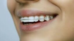 Fix Crooked Teeth Without Braces